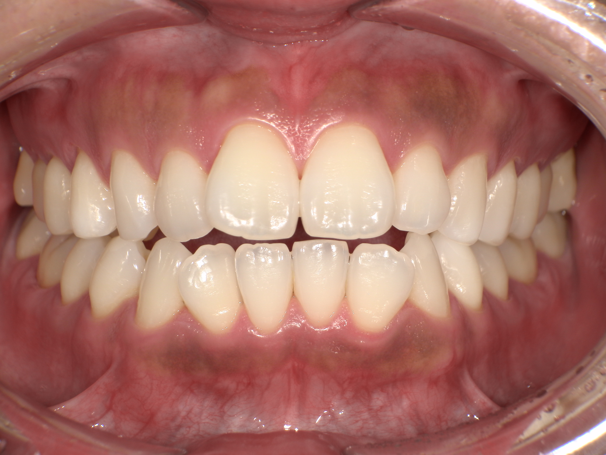 【治療前】歯並びがデコボコしている・口元が出ている・上下の歯の隙間(女性/30代)の口元