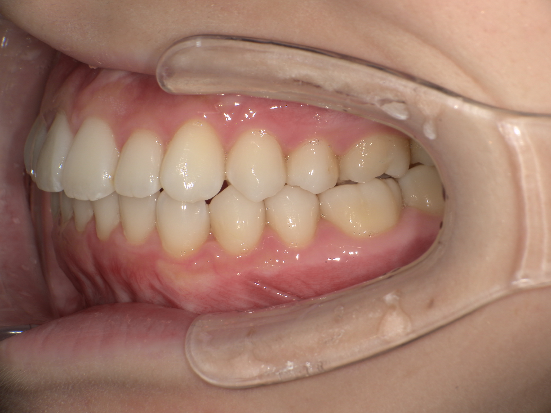 【治療後】上の歯が出ている(女性/20代)の口元