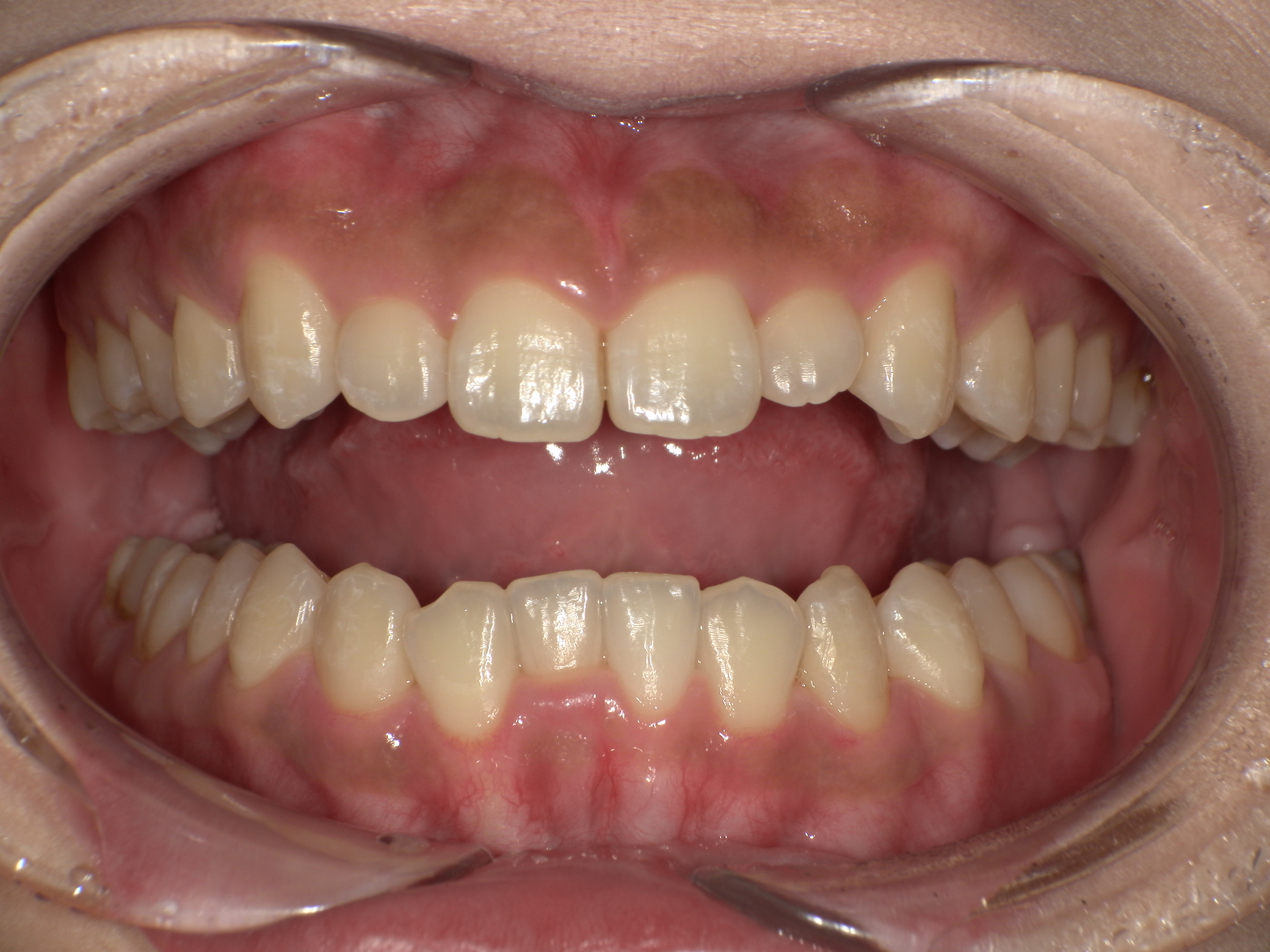 【治療後】前歯のがたつきが気になる(女性/20代)の口元