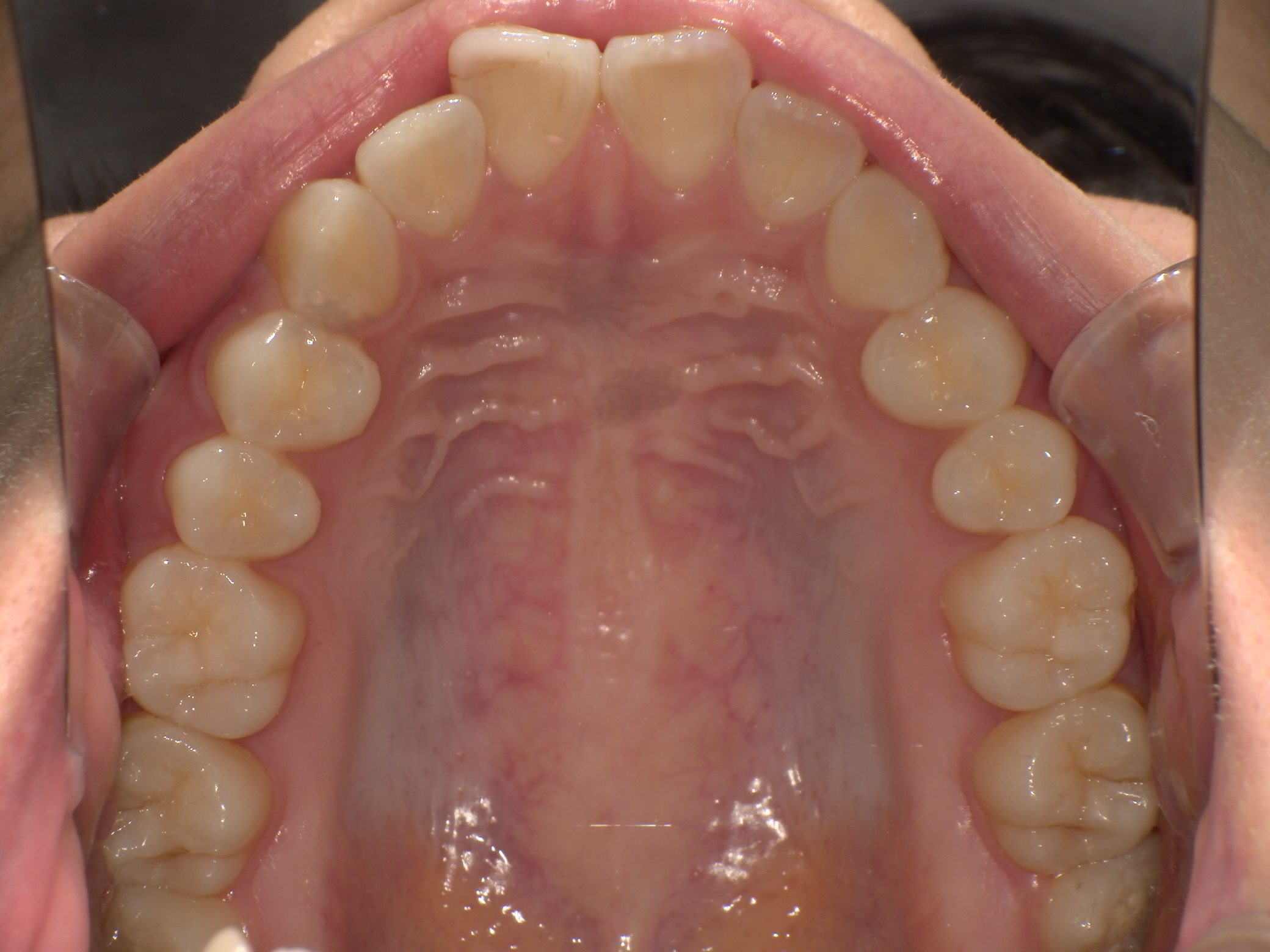 【治療前】上の歯が出ている(女性/20代)の口元