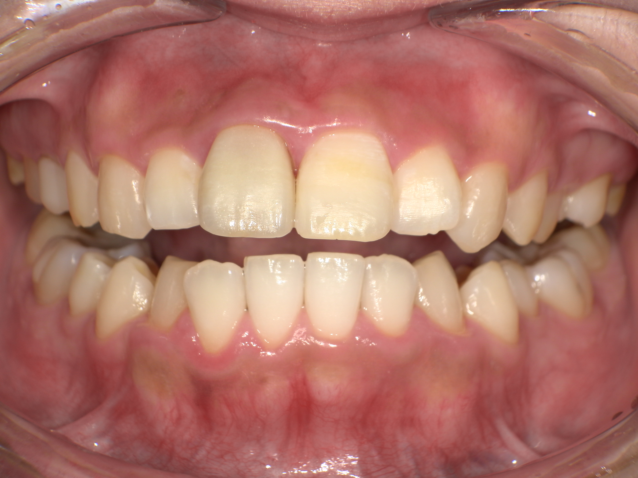 【治療前】上の歯が出ている(女性/20代)の口元