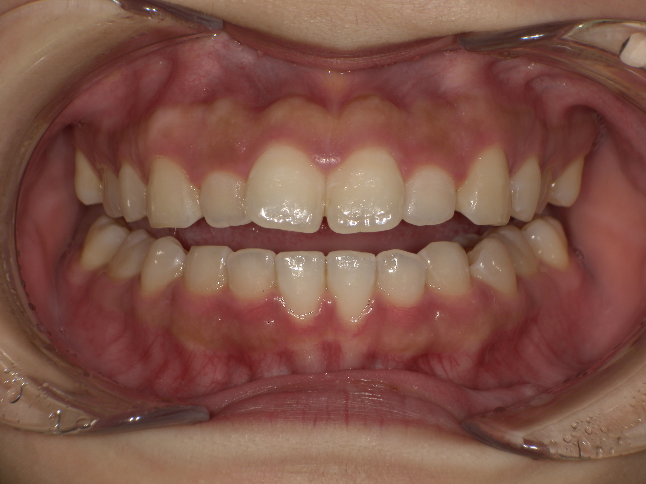 【治療前】上の歯が出ている・嚙み合わせが悪い(女性/20代)の口元