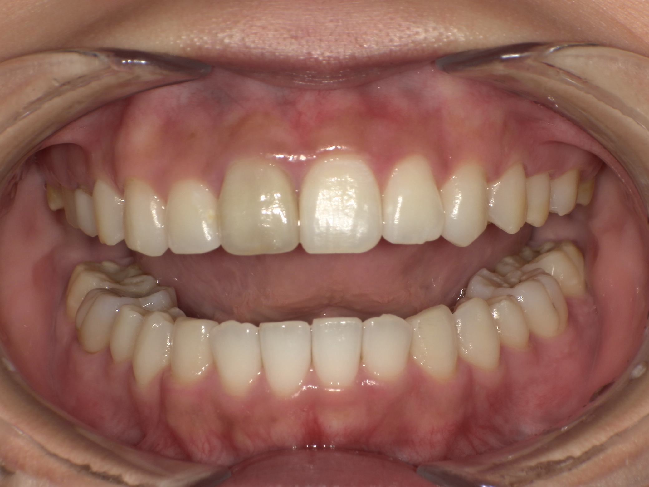 【治療後】上の歯が出ている(女性/20代)の口元