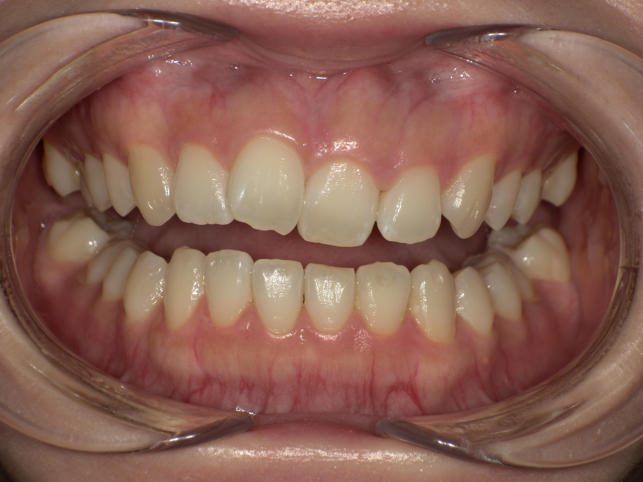 【治療前】歯並びがデコボコしている・前歯の中心のずれ(女性/30代)の口元