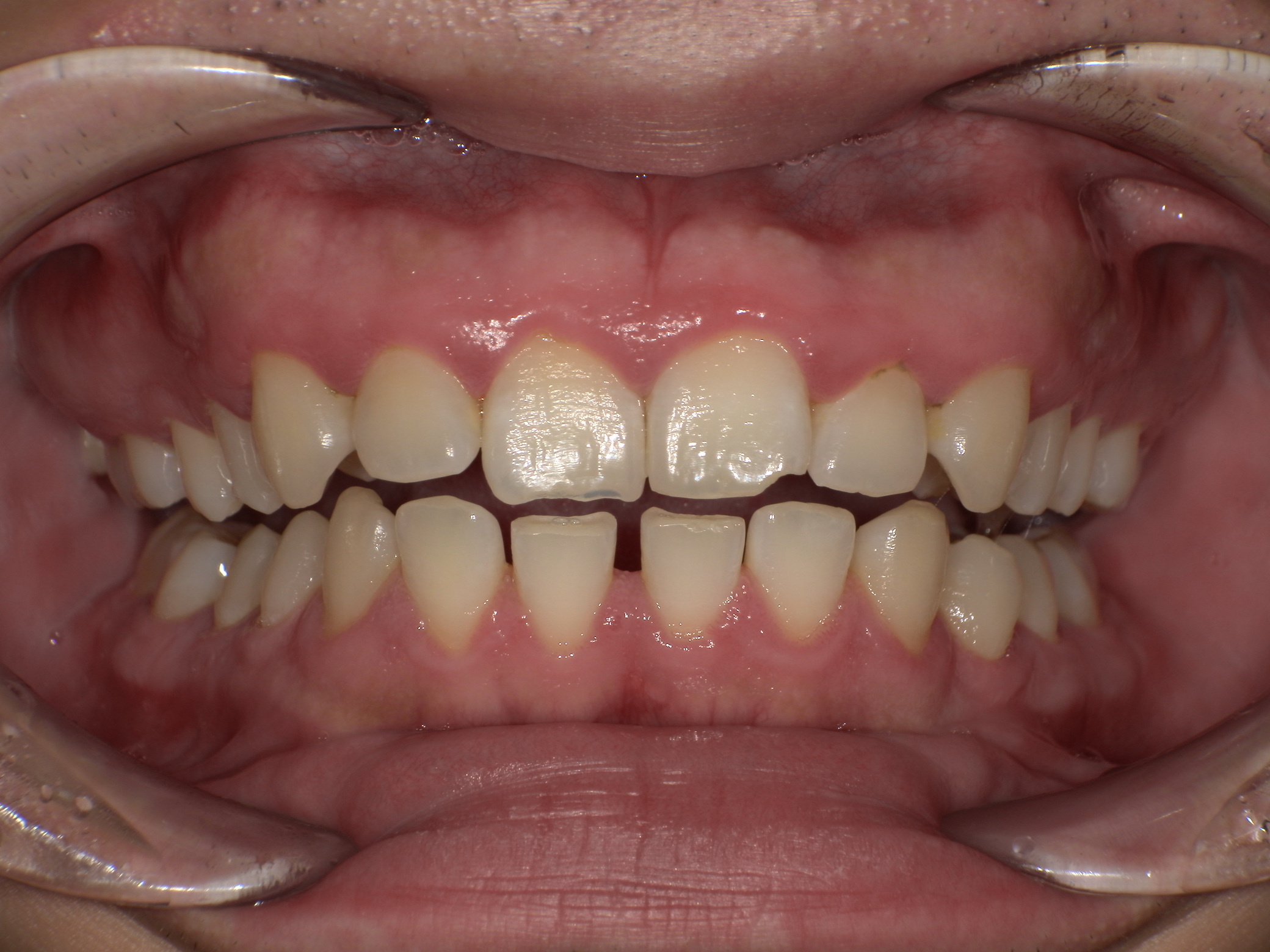 【治療前】口元下げたい、下の歯のすきっ歯気になる(男性/20代)の口元