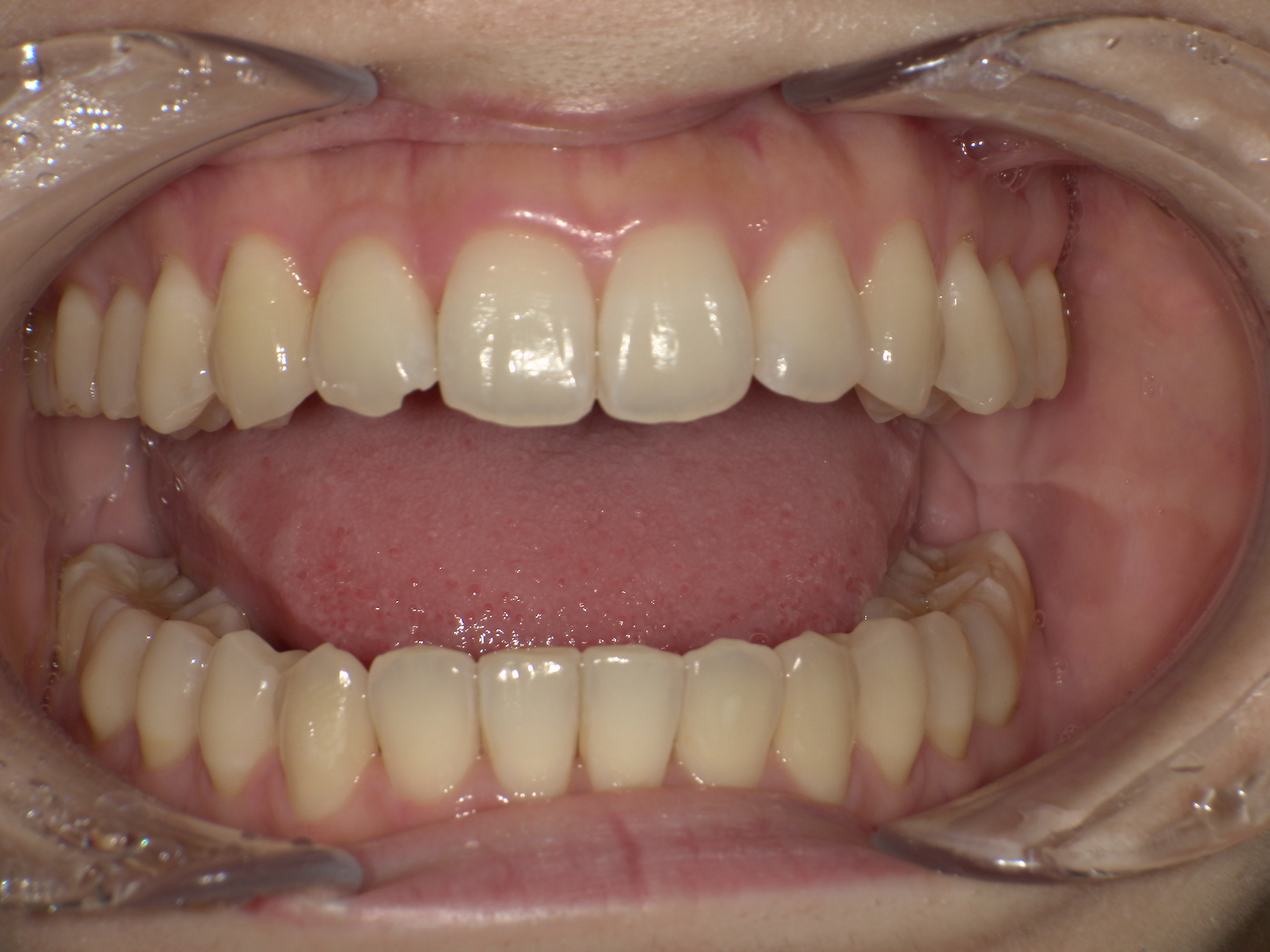 【治療後】前歯の中心のずれ・嚙み合わせが悪い(女性/20代)の口元