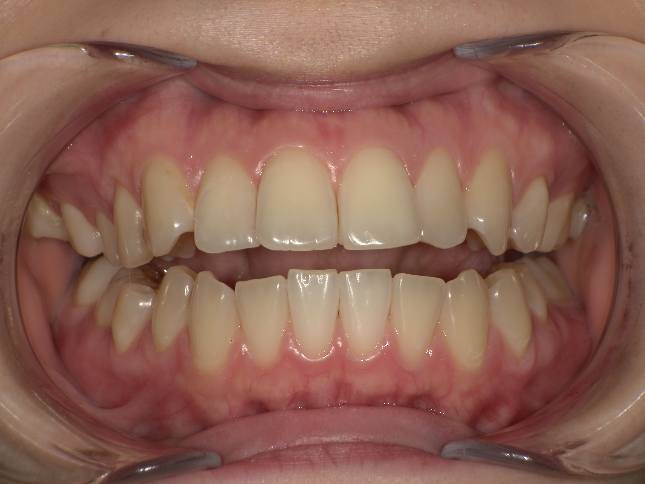 【治療前】上の歯が出ている・口元が出ている・嚙み合わせが悪い(女性/20代)の口元