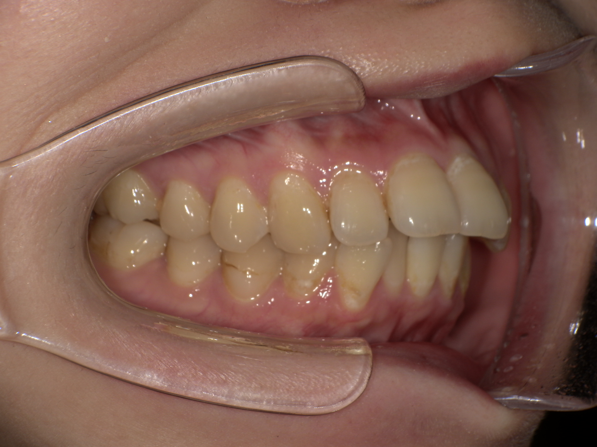 【治療前】歯並びがデコボコしている・上の歯が出ている(女性/30代)の口元