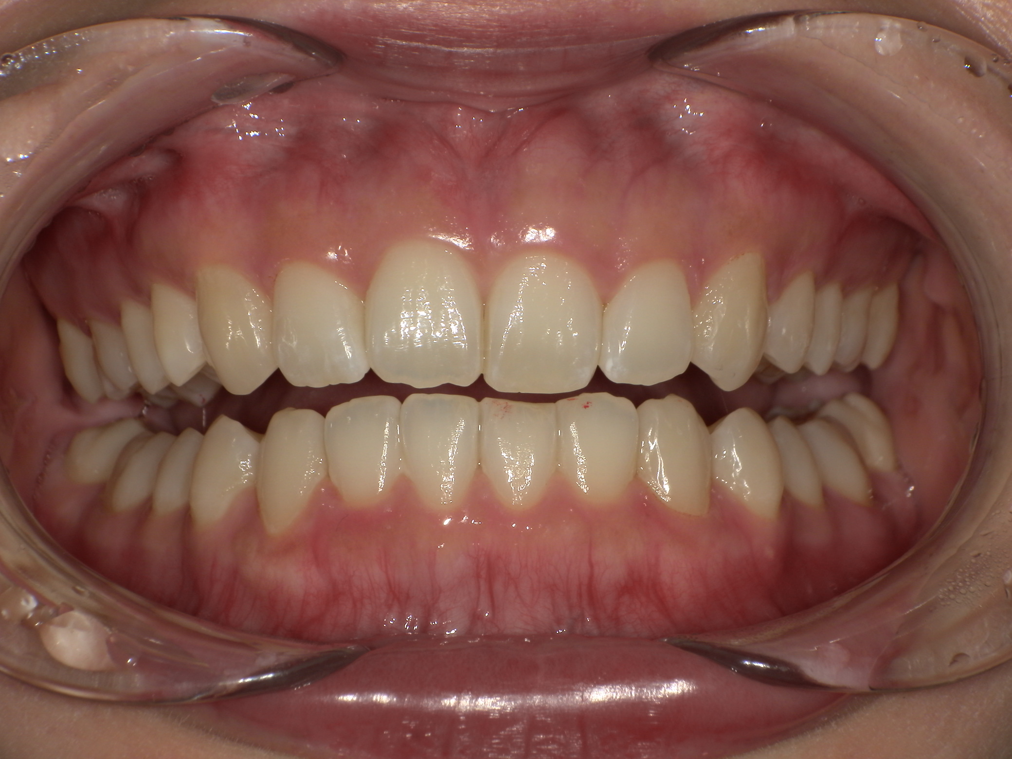 【治療後】歯並びがデコボコしている・前歯の中心のずれ(女性/30代)の口元