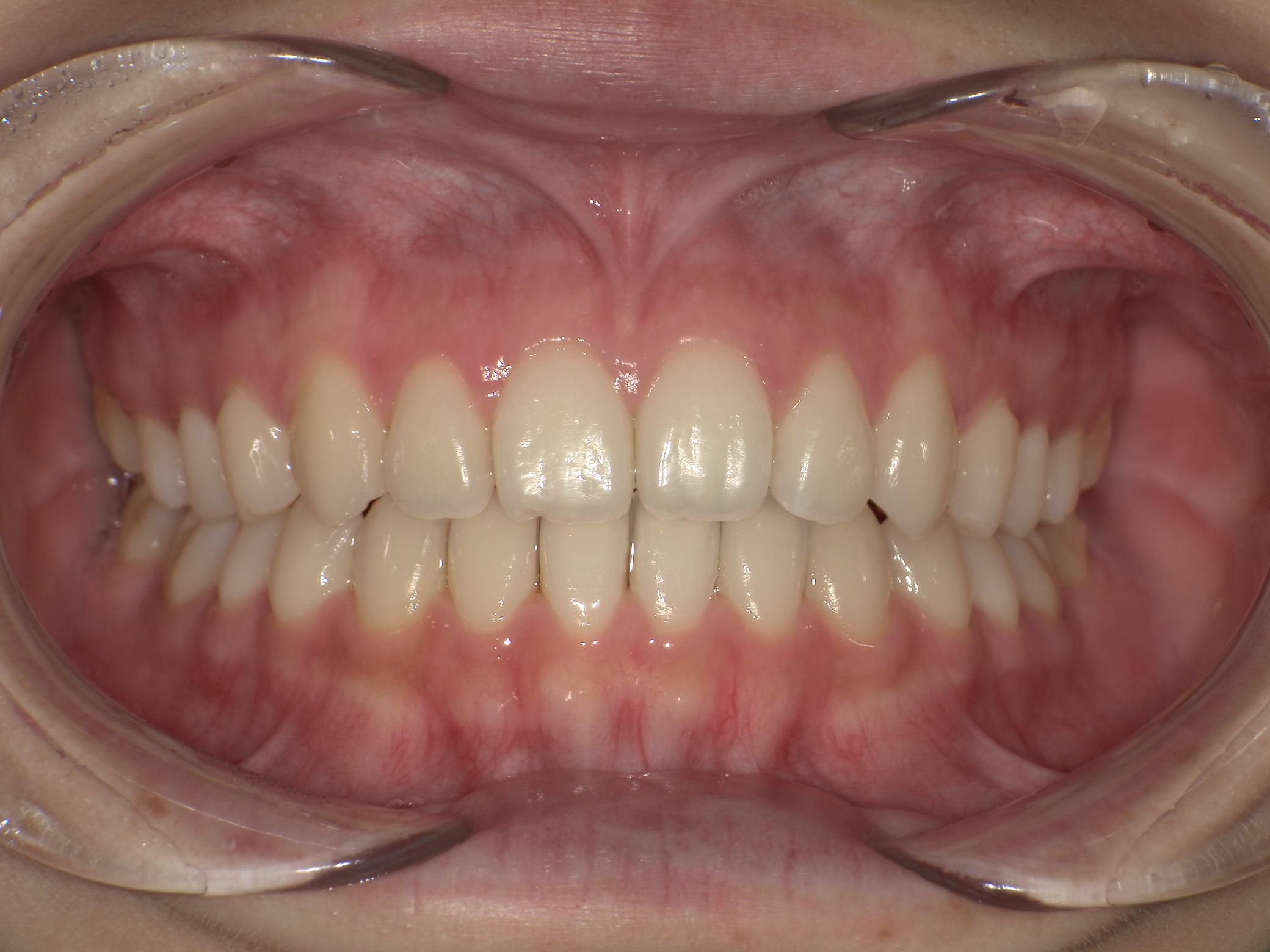 【治療後】横顔が気になる(女性/20代)の口元