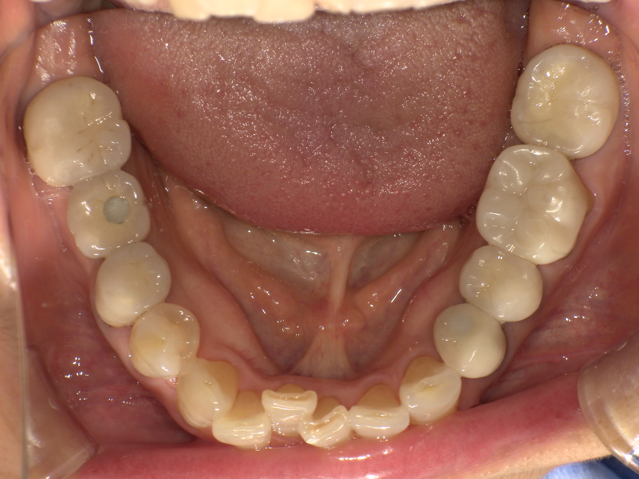 【治療前】前歯のガタガタが気になる(女性/50代)の口元