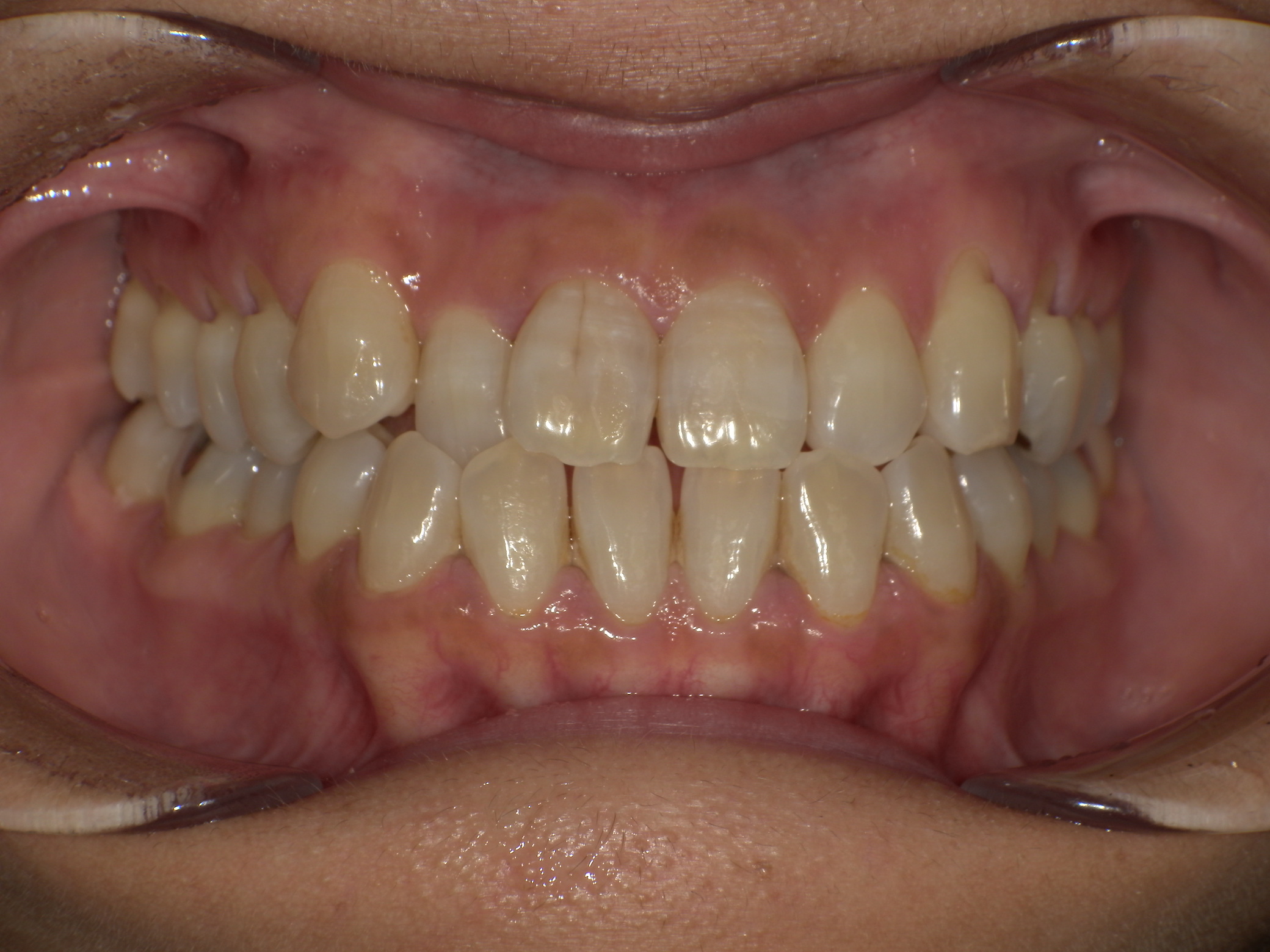 【治療前】歯並びがデコボコしている(女性/40代)の口元