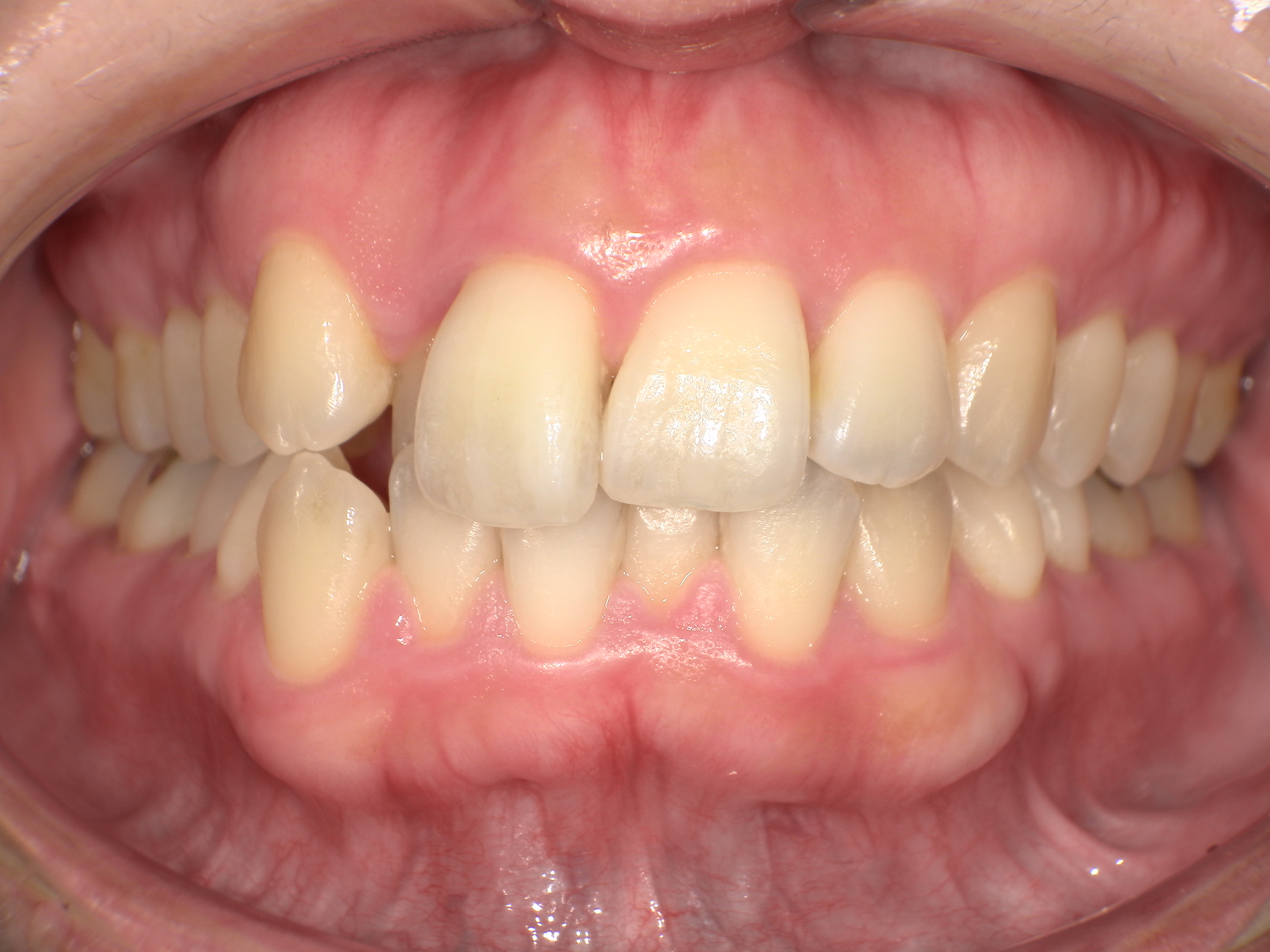 【治療前】歯並びがデコボコしている(女性/40代)の口元