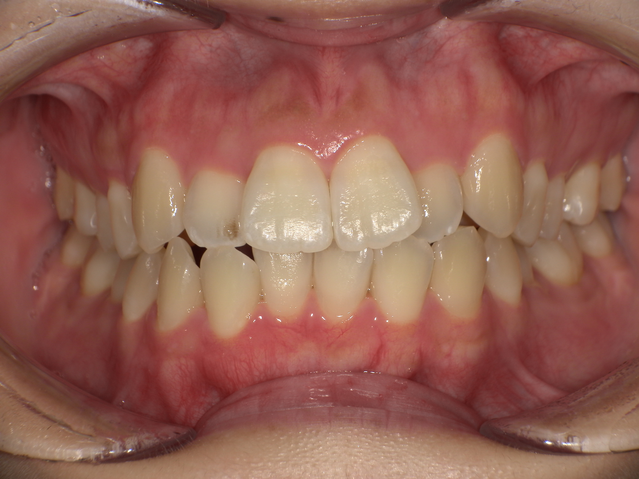 【治療前】歯並びがデコボコしている・上の歯が出ている・笑った時の歯と歯茎の見え方(女性/20代)の口元