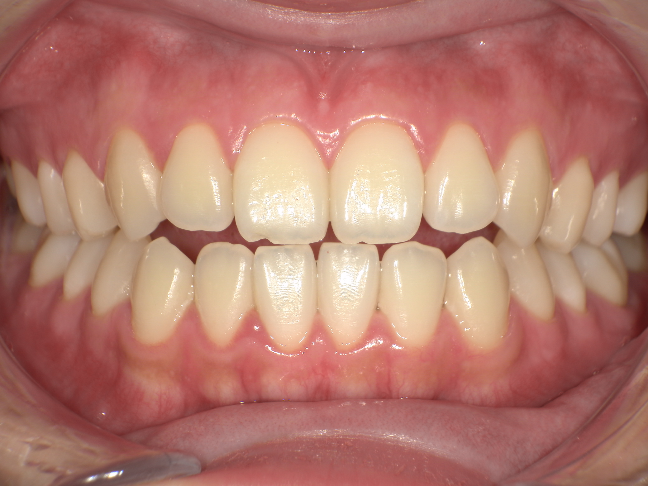 【治療前】横顔が気になる(女性/20代)の口元