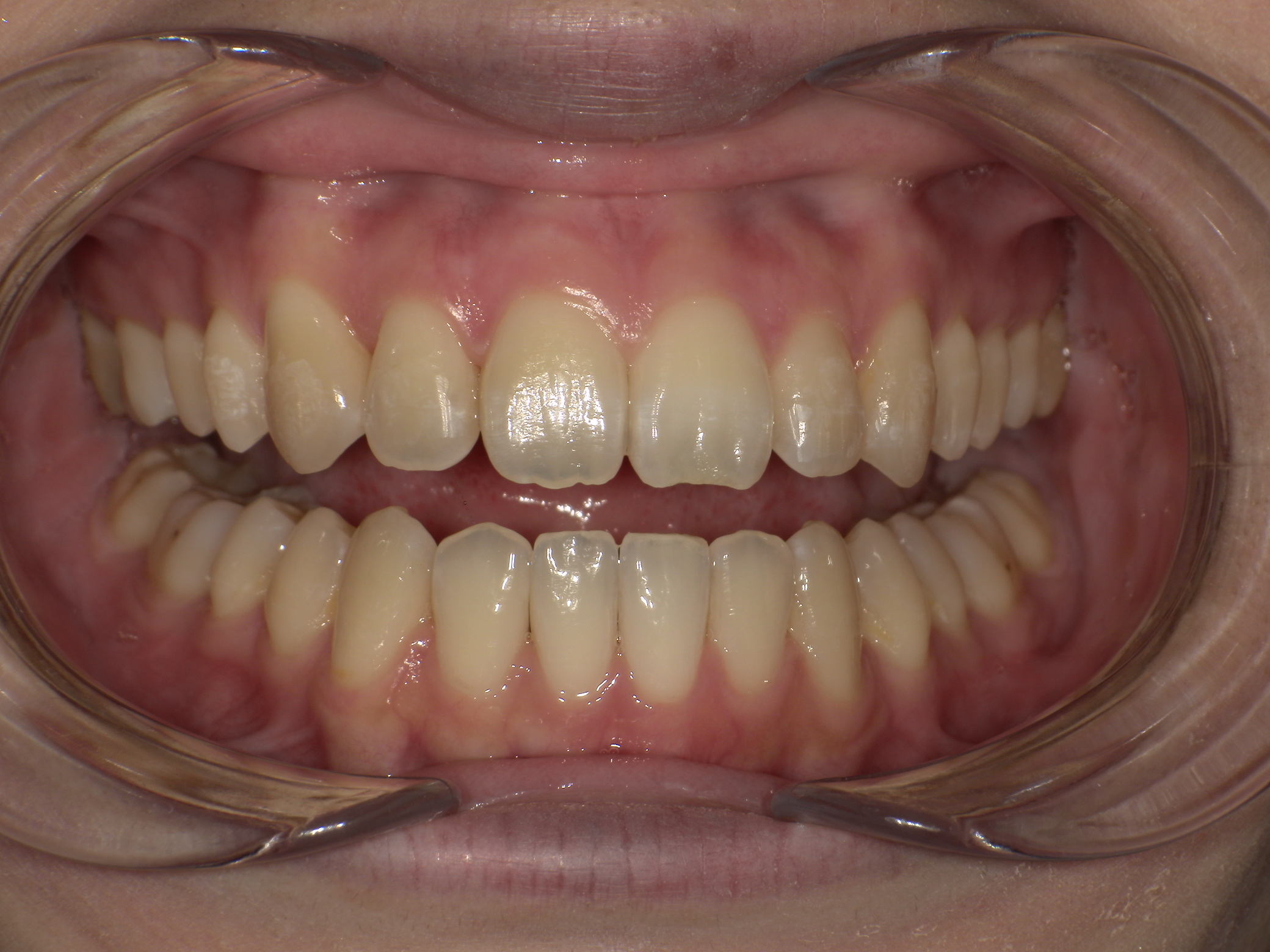 【治療後】口元が出ているのが気になる(女性/30代)の口元