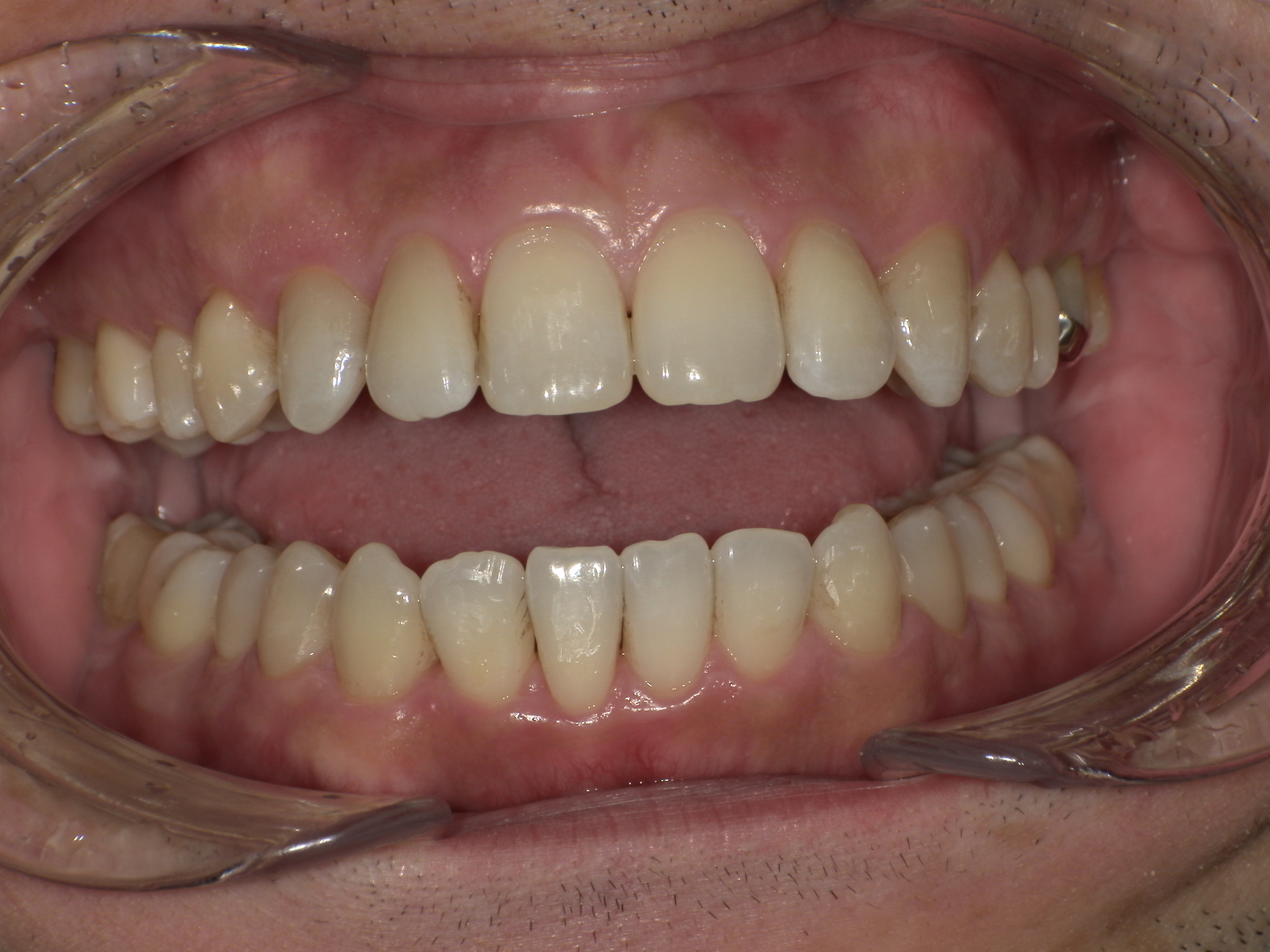 【治療後】前歯のがたつき、上下の歯の嚙み合わせがずれている(男性/40代)の口元