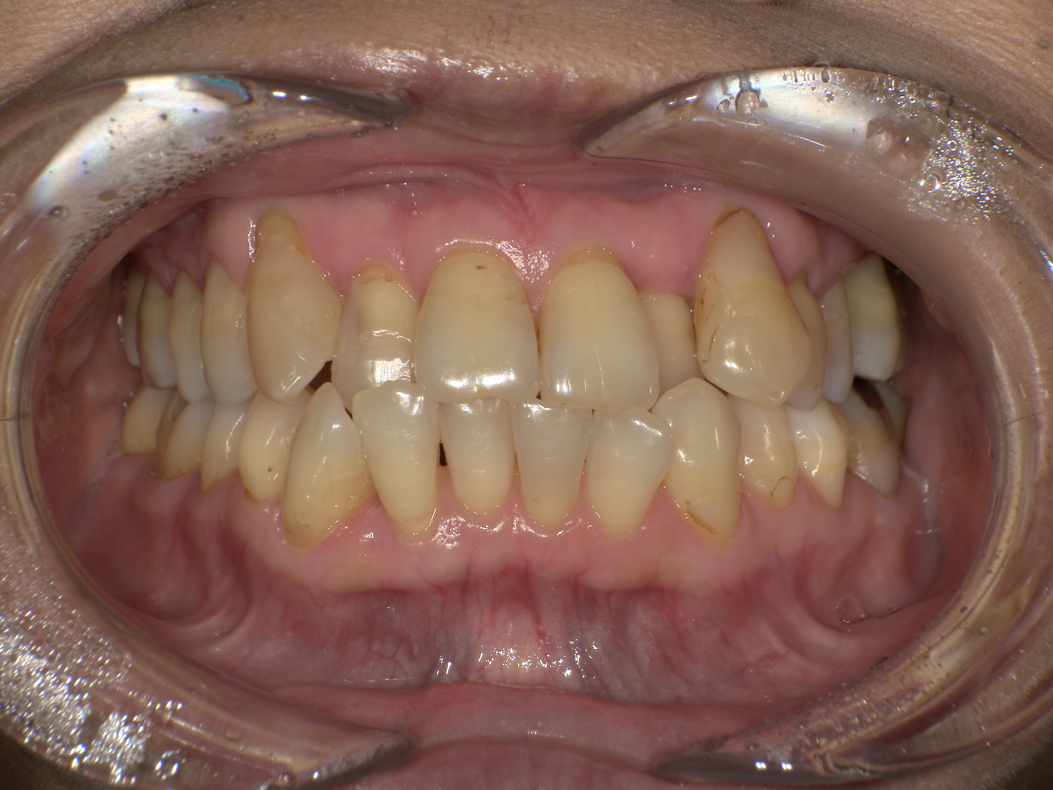 【治療前】前歯のがたつきが気になる(女性/50代)の口元