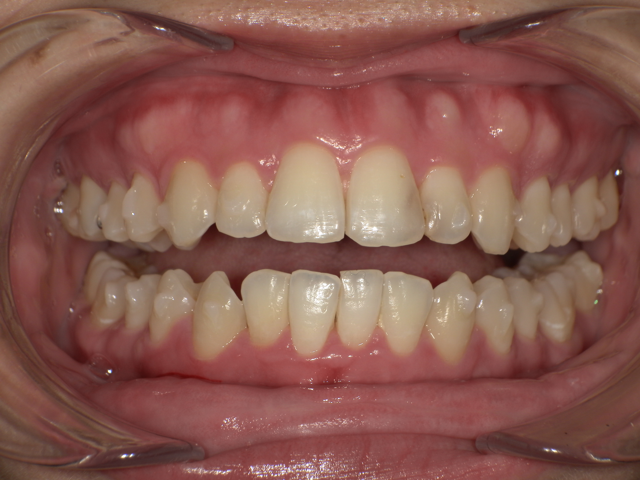 【治療後】歯並びがデコボコしている、上の歯が出ている(女性/20代)の口元