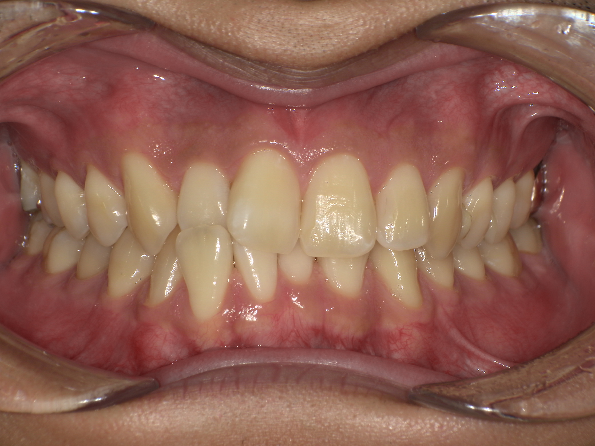 【治療前】歯並びがデコボコしている(男性/30代)の口元