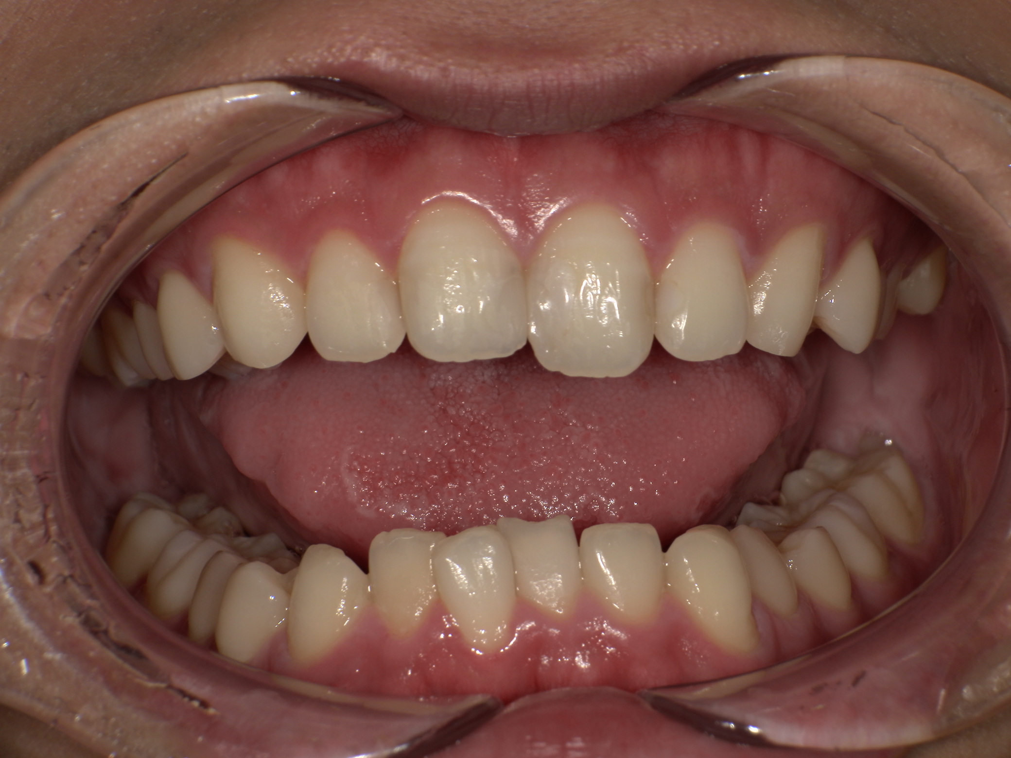 【治療前】歯並びがデコボコしている・前歯の中心のずれが気になる(男性/20代)の口元