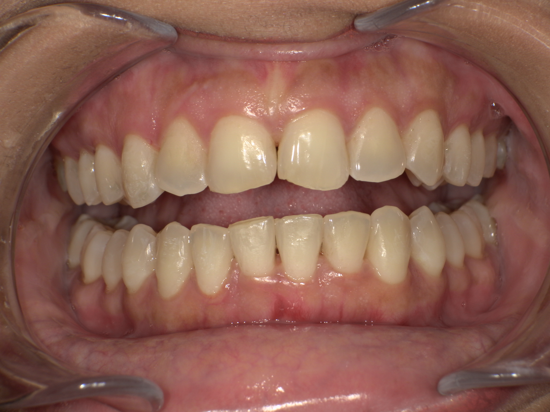 【治療後】前歯のがたつきが気になる(女性/30代)の口元