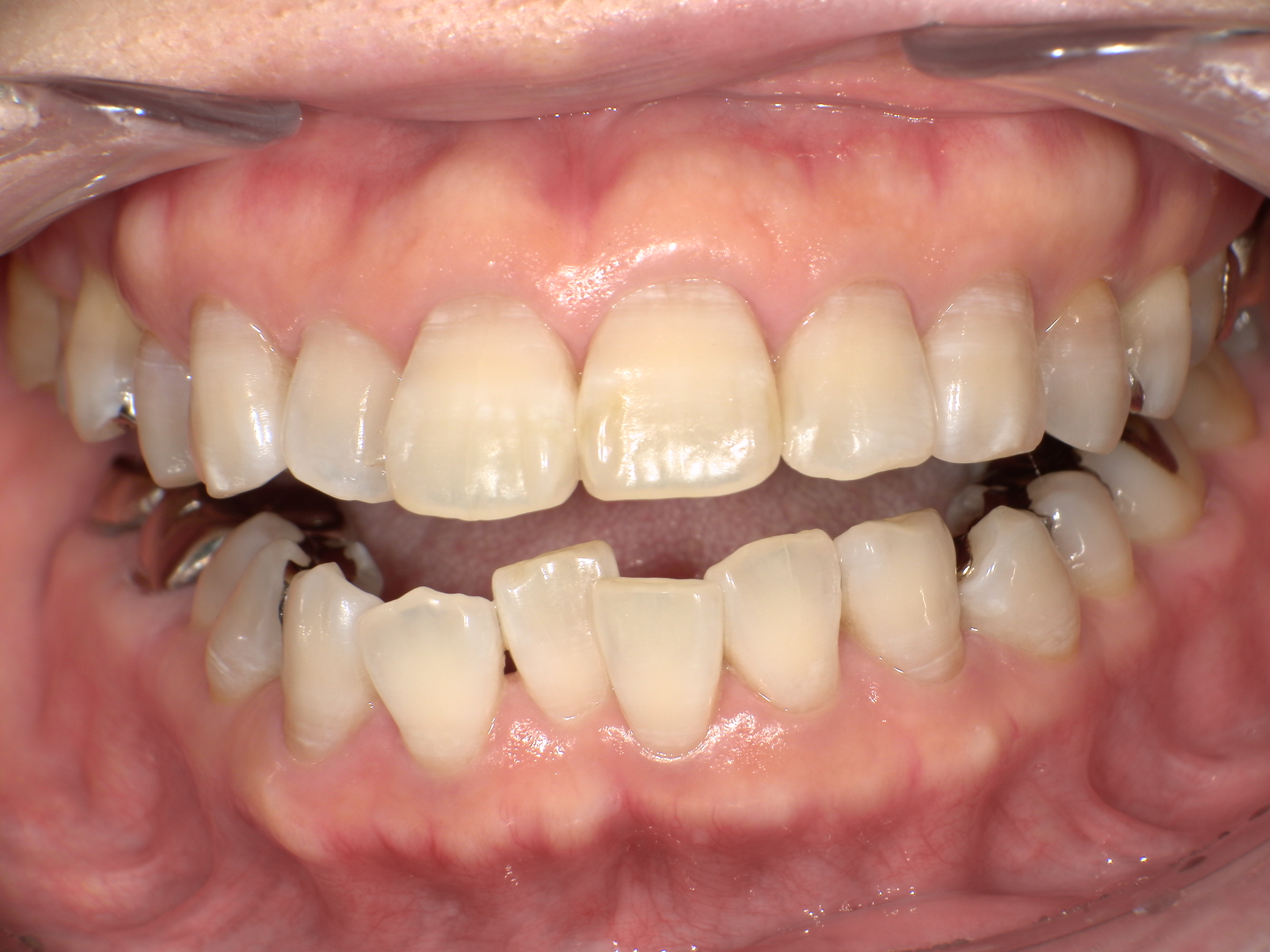 【治療前】上の歯が出ている(女性/50代)の口元