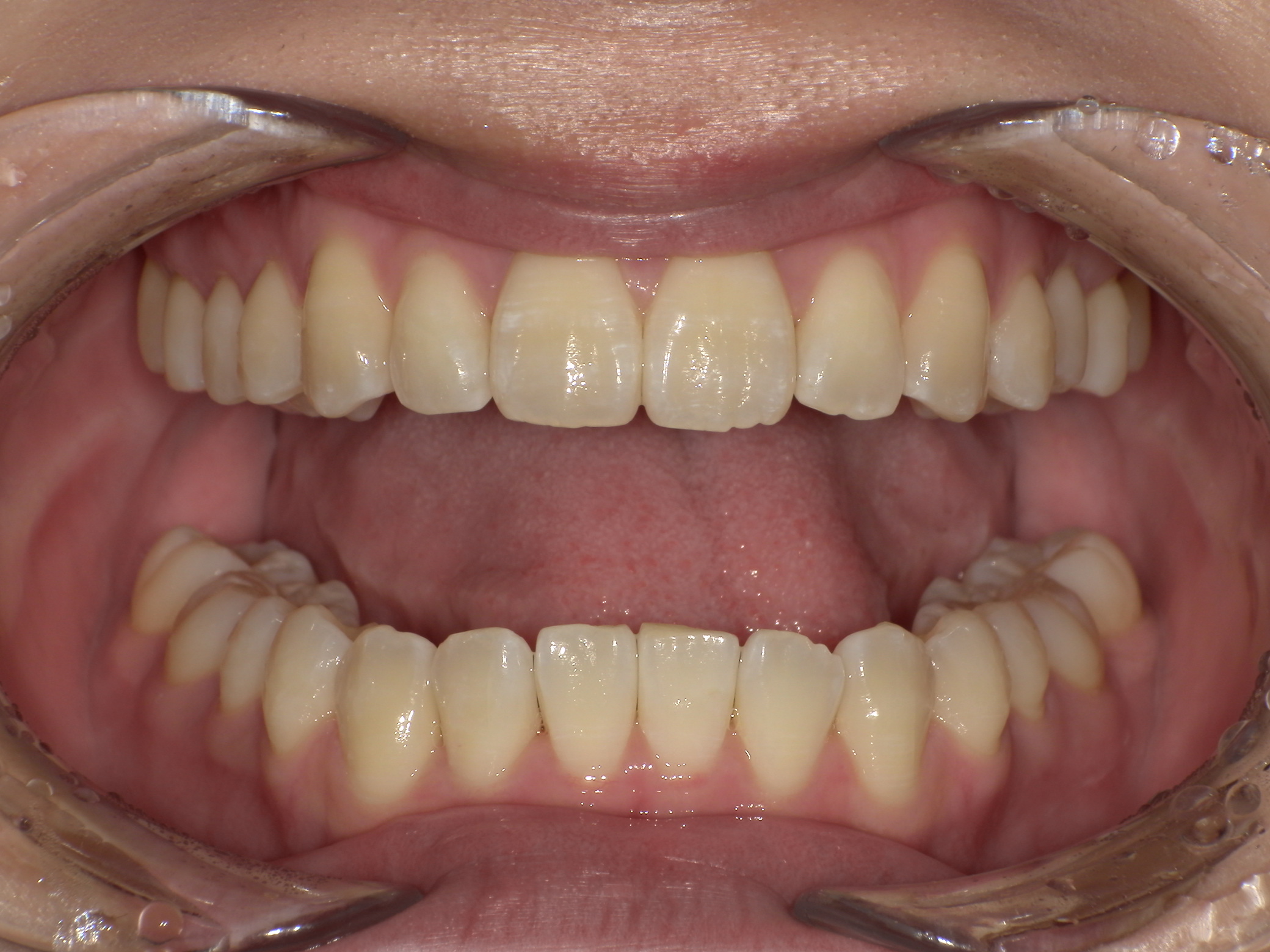 【治療後】歯並びがデコボコしている(女性/20代)の口元