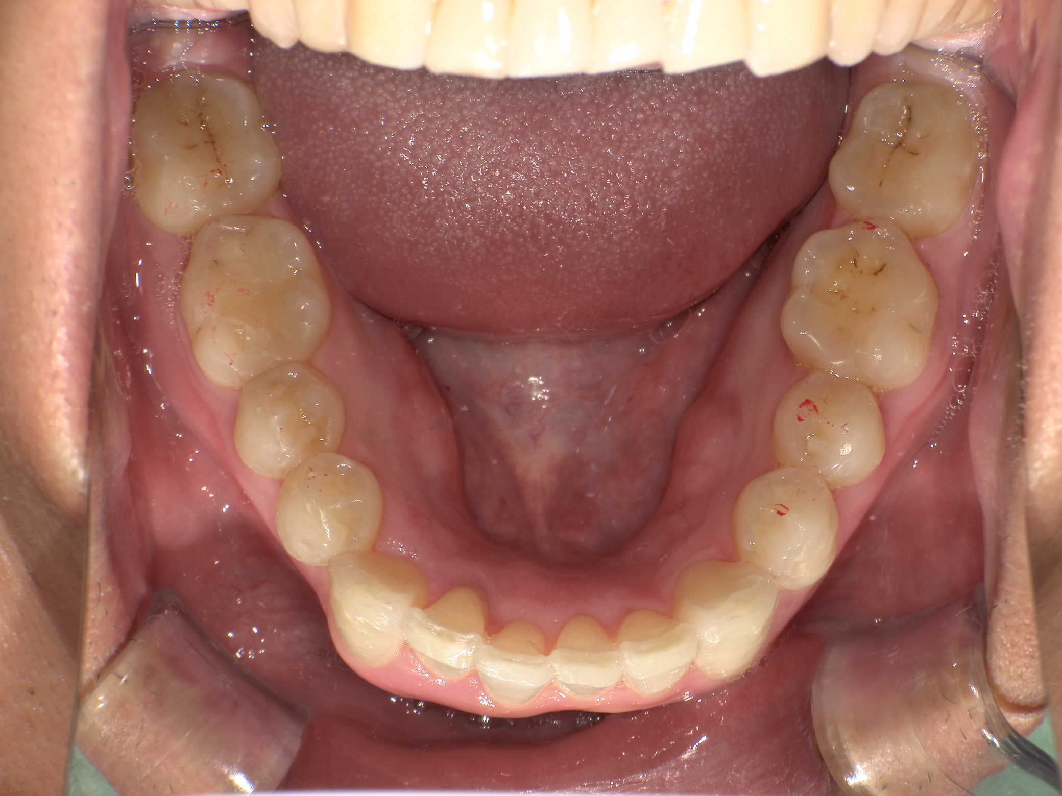 【治療後】歯並びがデコボコしている(男性/30代)の口元